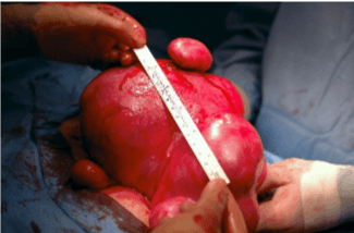 Fibroids photo 2