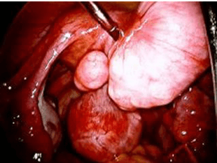 Fibroids photo