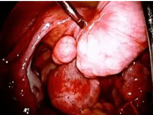 Fibroids photo