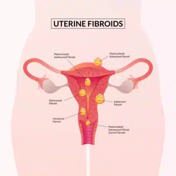 Uterine fibroids