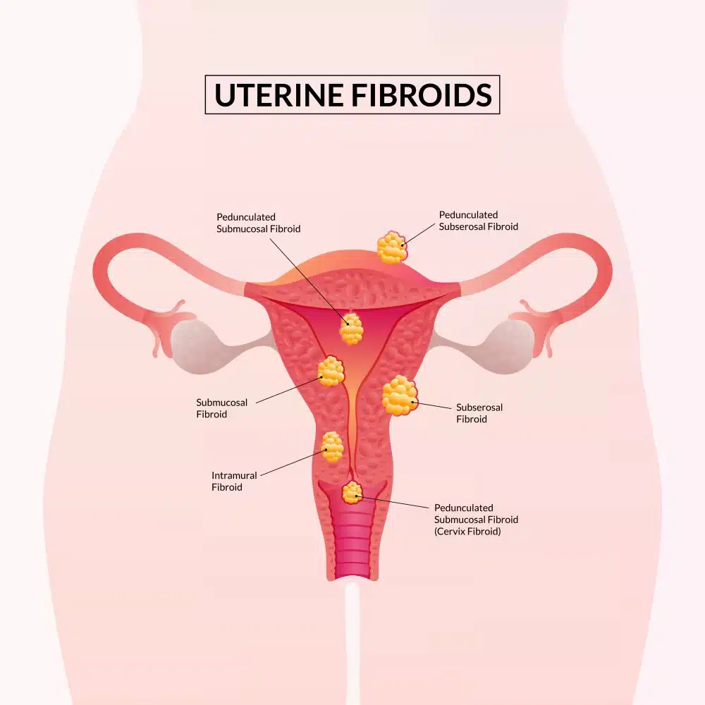 All You Need to Know About Fibroids | Astra Women's Specialists, image size:1000x1000