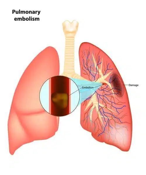 pulmonary embolism info