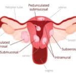 what are fibroids
