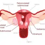 what are fibroids