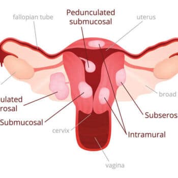 what are fibroids