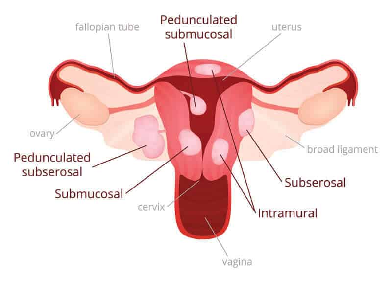 what are fibroids