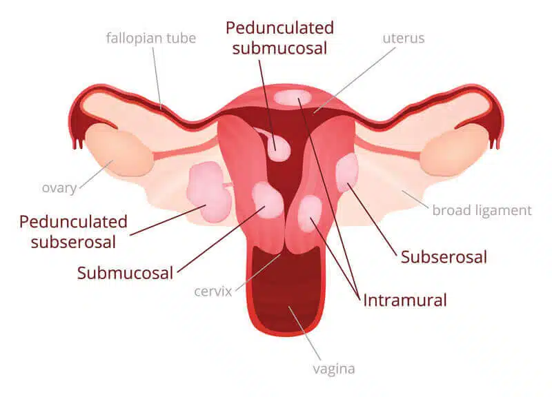 what are fibroids